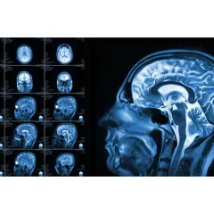 Fizjoterapeuta a rezonans magnetyczny (MRI): kto wystawia skierowanie?