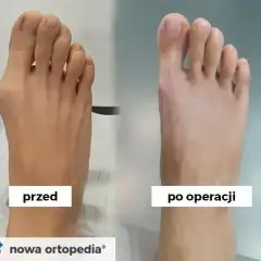 Po operacji haluksa: Kiedy wrócisz do ulubionych butów?