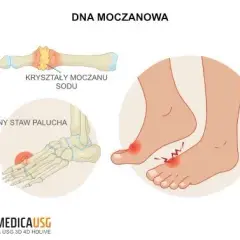 Dna moczanowa czy haluks? Odkryj przyczynę bólu dużego palca