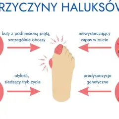 Haluksy dziedziczne? Jak zapobiegać, gdy masz predyspozycje