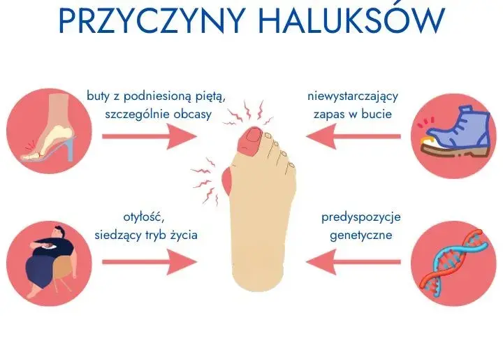 Haluksy dziedziczne? Jak zapobiegać, gdy masz predyspozycje