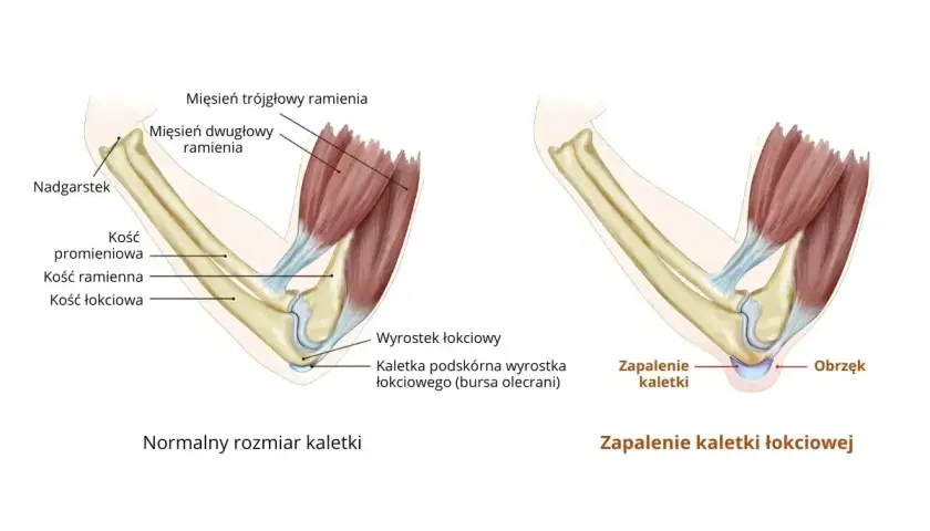 Spuchnięty łokieć bez przyczyny. Ilustracja pokazuje zapalenie kaletki łokciowej, powodujące obrzęk.