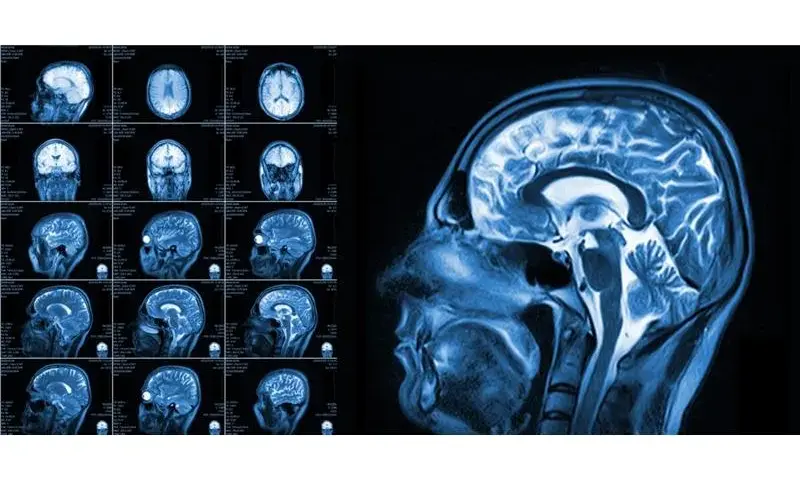 Fizjoterapeuta a rezonans magnetyczny (MRI): kto wystawia skierowanie?