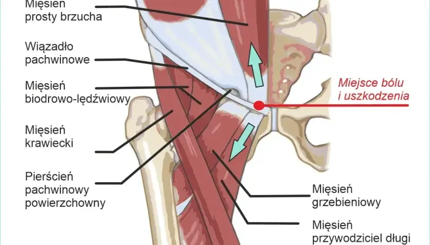 Anatomia mięśni pachwiny i biodra. Czerwona kropka wskazuje miejsce bólu i uszkodzenia, często związane z problemami, które powodują ból lędźwi.