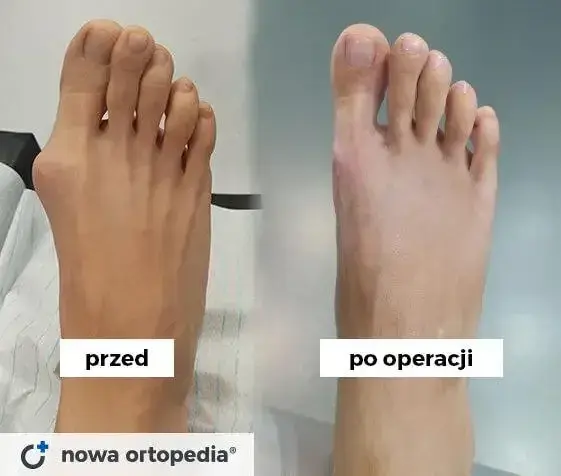 Po operacji haluksa: Kiedy wrócisz do ulubionych butów?