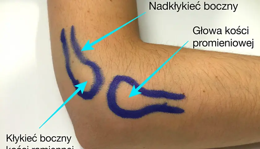Oznaczenia na ramieniu wskazują obszary do masażu przy łokciu tenisisty.