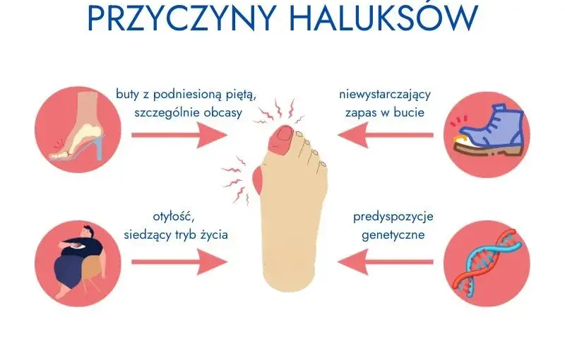 Haluksy dziedziczne? Jak zapobiegać, gdy masz predyspozycje