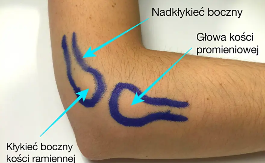 Masaż przy łokciu tenisisty - kiedy pomaga, a kiedy szkodzi