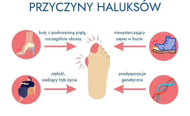 Haluksy dziedziczne? Jak zapobiegać, gdy masz predyspozycje