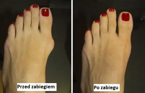 Operacja haluksa: Koszty prywatnie vs NFZ. Uniknij ukrytych opłat!