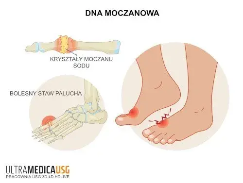 Dna moczanowa czy haluks? Odkryj przyczynę bólu dużego palca
