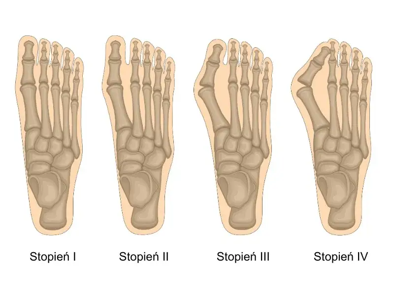 anatomia stopy haluks deformacja