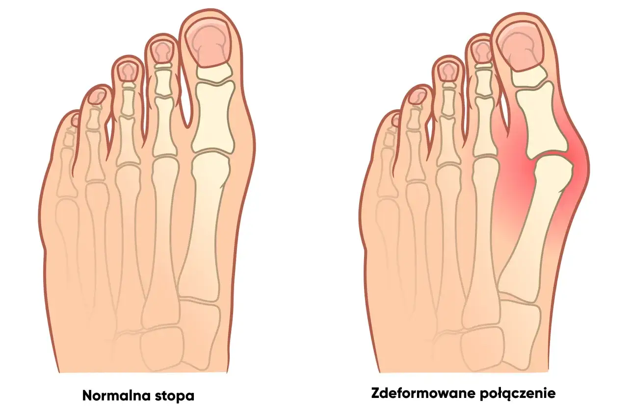 Nieodpowiednie obuwie haluksy