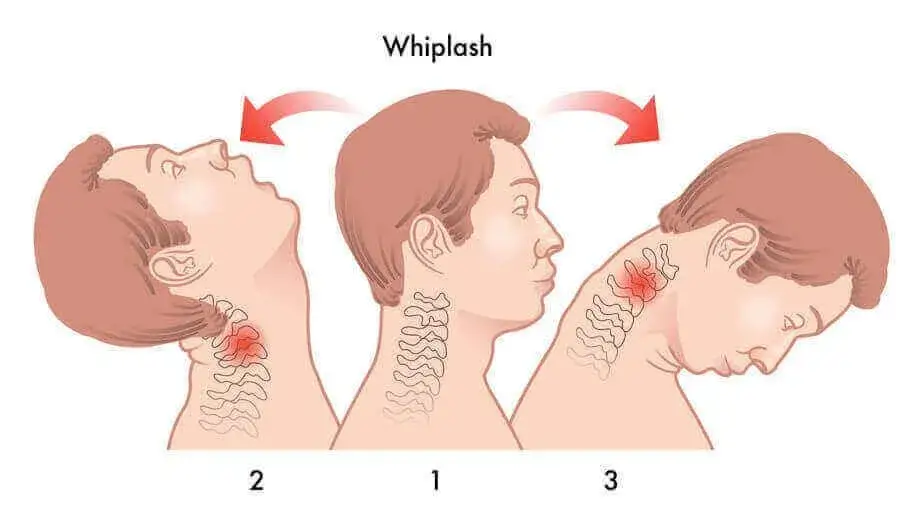schemat kręgosłupa szyjnego uraz whiplash