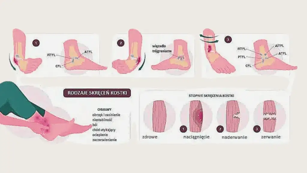 stopnie skręcenia więzadeł grafika