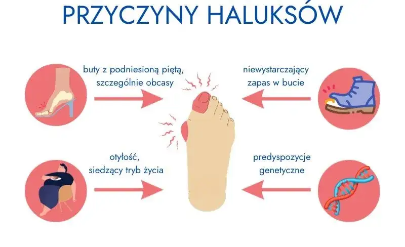 haluksy przyczyny obuwie budowa stopy