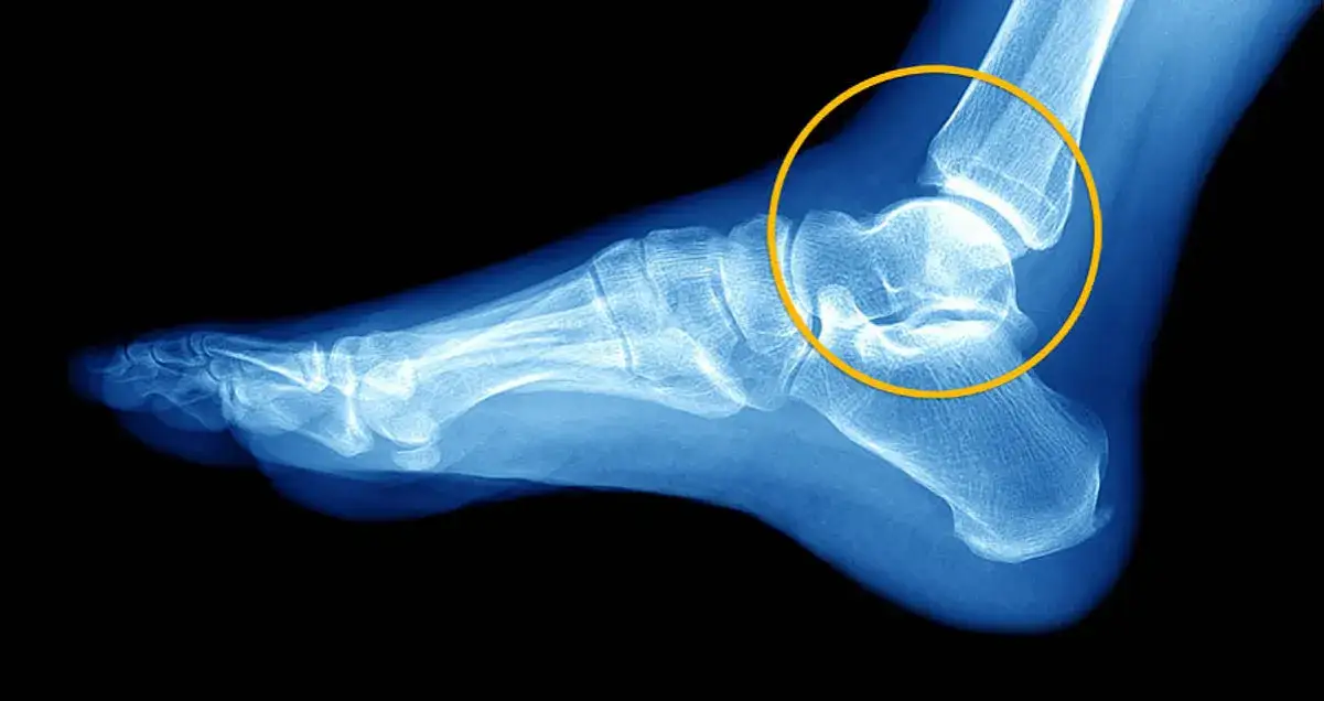 diagnostyka skręconej kostki RTG USG