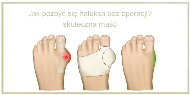 Metody leczenia haluksów bez operacji