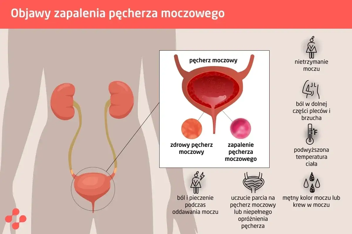 kiedy iść do lekarza zapalenie pęcherza, objawy alarmowe