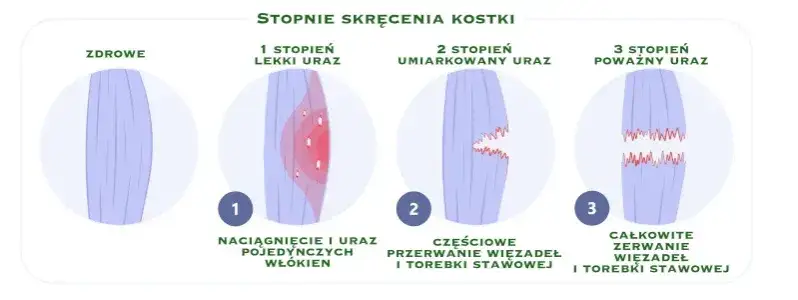 stopnie skręcenia stawu skokowego infografika
