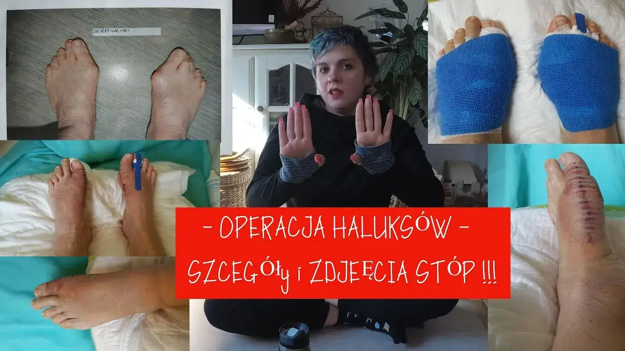 Koszt operacji haluksa wykres porównanie NFZ prywatnie