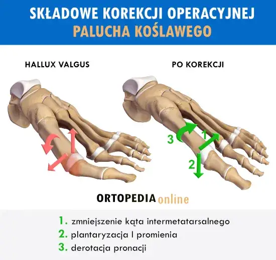 operacja haluksa schemat osteotomia