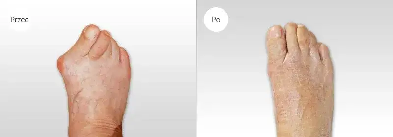 Operacja haluksa przed i po