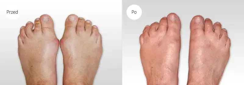 powikłania po operacji haluksa, stopa po operacji