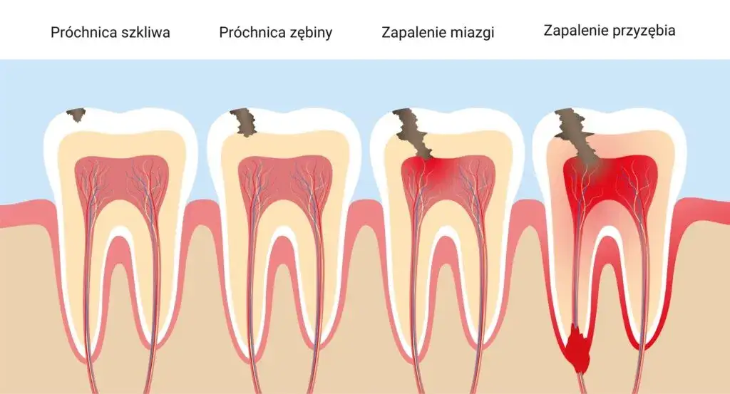 różne przyczyny bólu zęba infografika