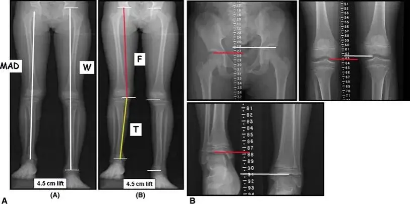 różnica długości nóg anatomiczna funkcjonalna
