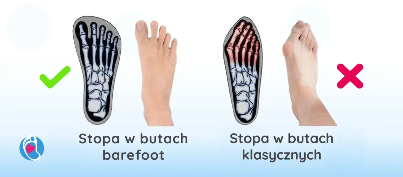 buty na haluksy przed i po rozciąganiu