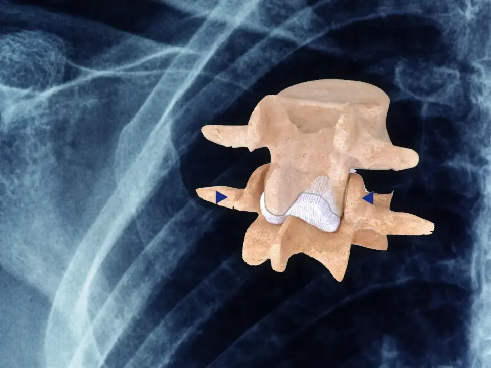 Stabilizacja międzykolczysta - kiedy implant naprawdę pomaga?